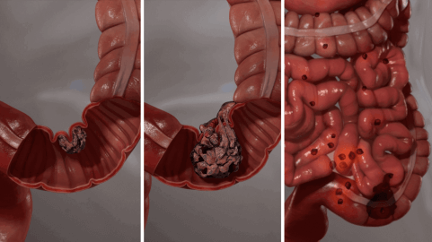 Illustration of Polyp in a colon